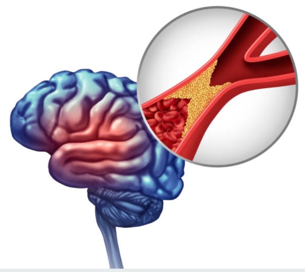 Brain Stroke Symptoms